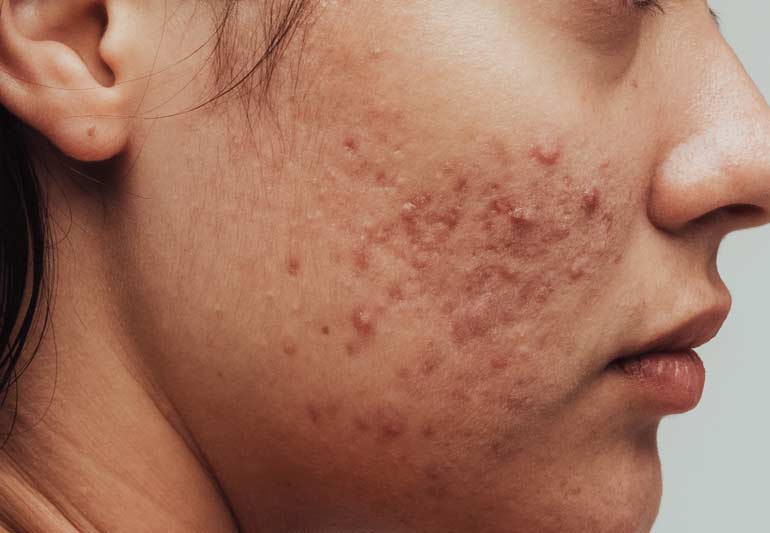 Homeopathy Treatment for Pimples In Kurnool