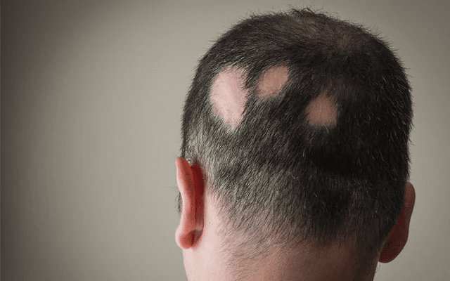 Homeopathy Treatment for Alopecia In Kurnool