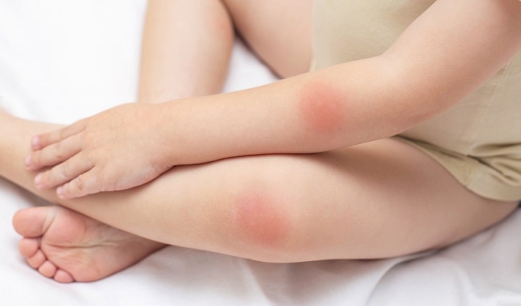 Homeopathy Treatment for Cellulitis in Children In Kurnool