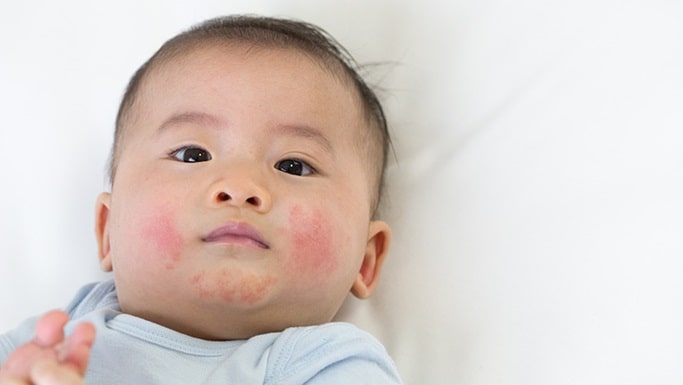 Homeopathy Treatment for Eczema in Children In Kurnool