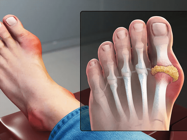 Homeopathy Treatment for Gout Arthritis In Kurnool