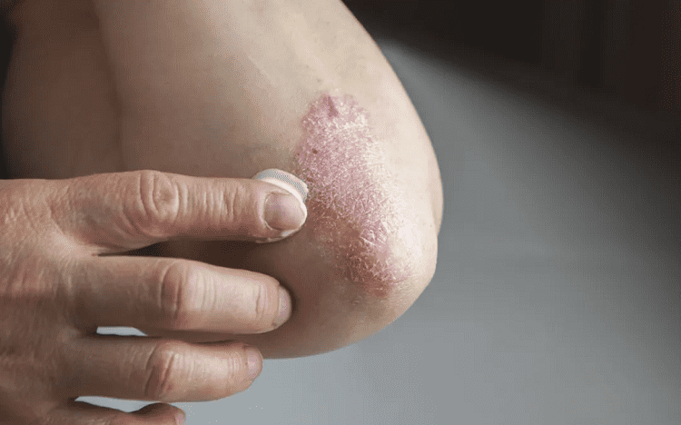 Homeopathy Treatment for Psoriasis In Kurnool