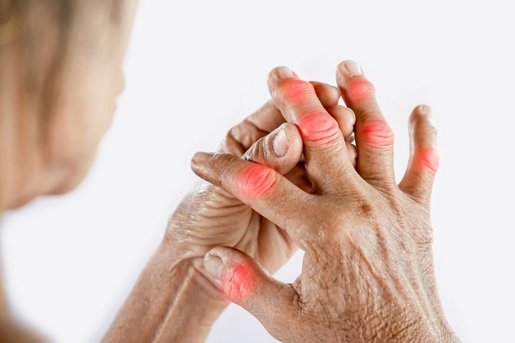 Homeopathy Treatment for Psoriatic Arthritis In Kurnool