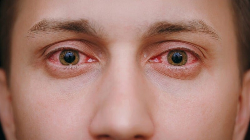 Homeopathy Treatment for Allergic Conjunctivitis In Kurnool