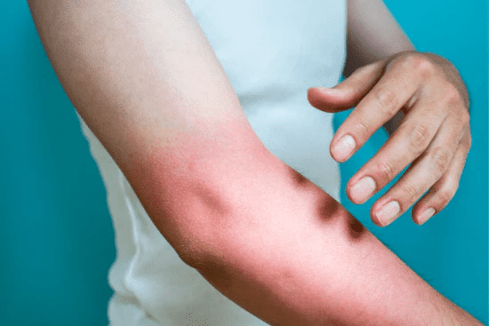 Homeopathy Treatment for Sun Allergy In Kurnool