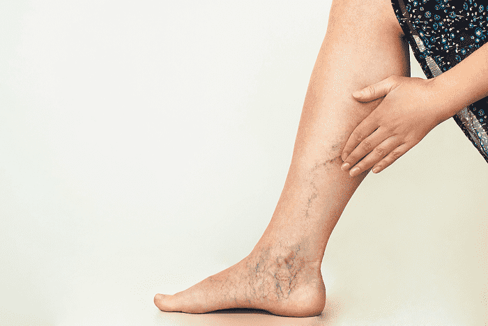 Homeopathy Treatment for Varicose Veins In Kurnool